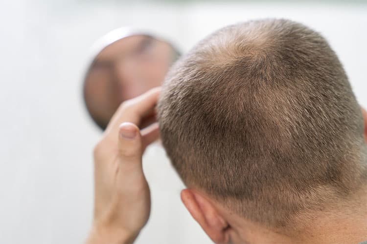 Fases de la caída del cabello: Escala Hamilton-Norwood
