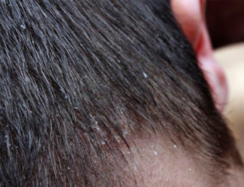 ¿Qué es la Dermatitis Seborreica en el cuero cabelludo?