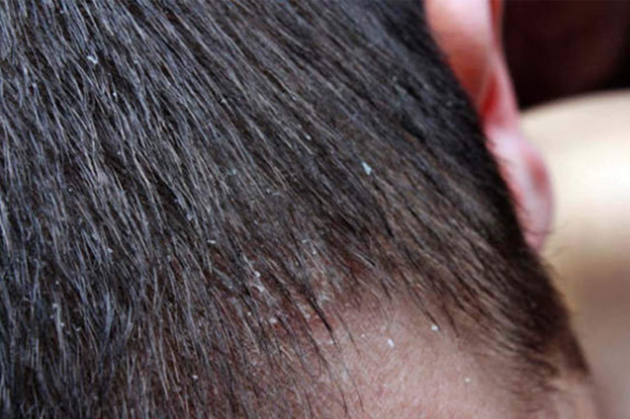 Qué es Dermatitis Seborreica en cuero cabelludo?
