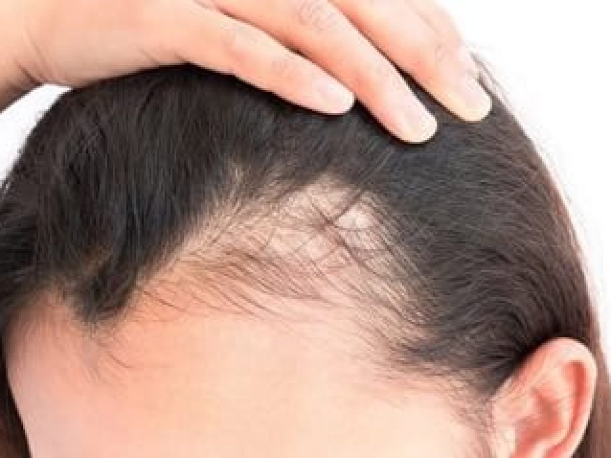 Como estrés puede acelerar la de cabello | Kmax España