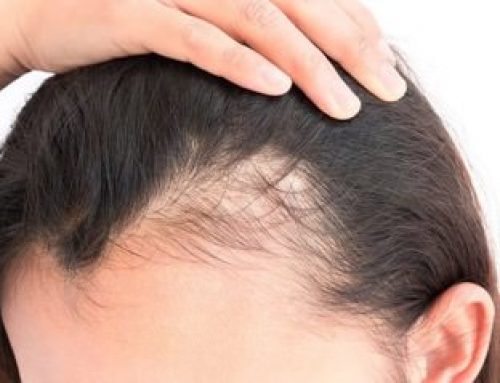 Cómo el estrés puede acelerar la pérdida de cabello: nuestros consejos para frenar la caída.