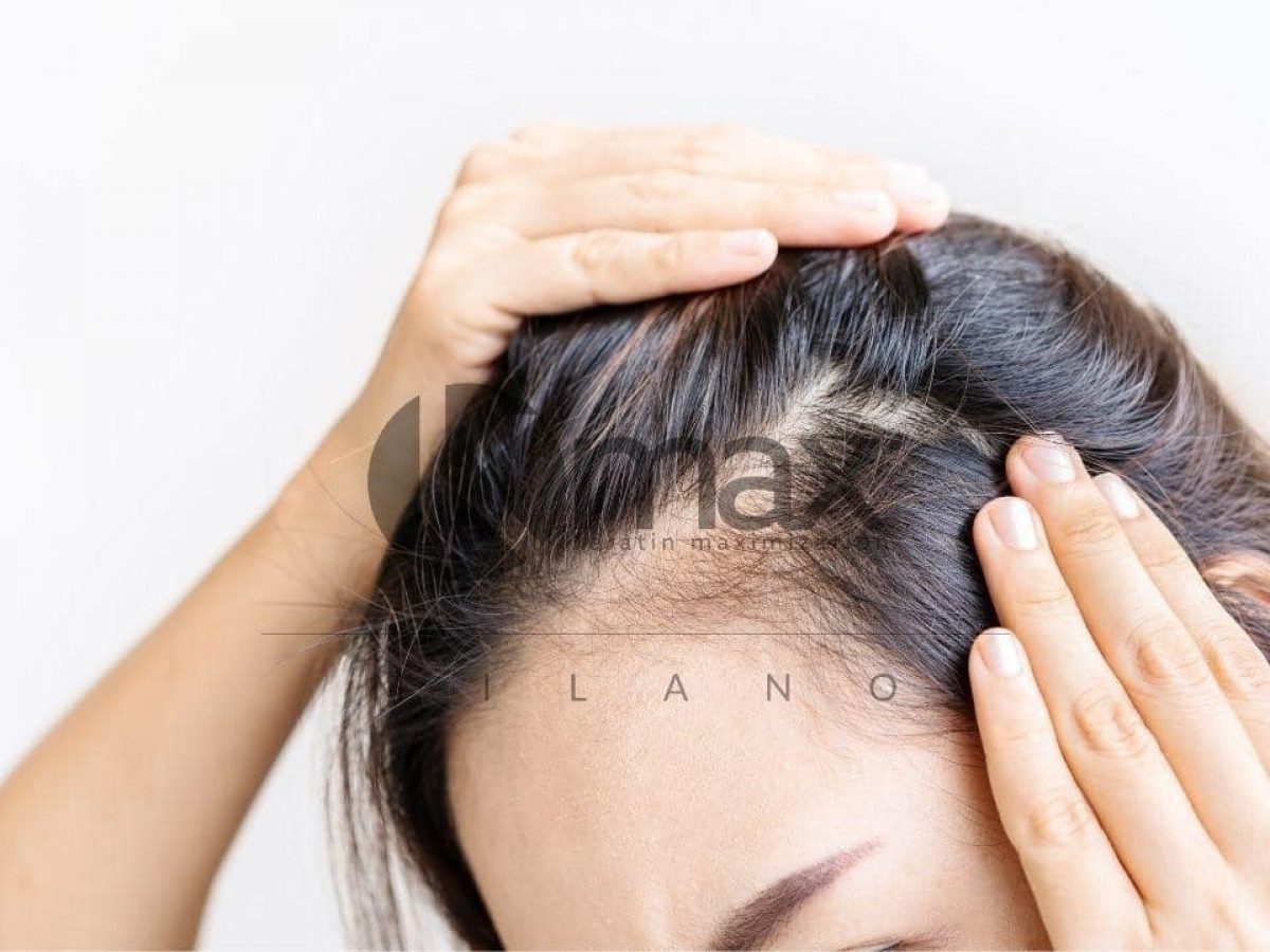 Alopecia femenina: explicados por el Tricólogo - Kmax España