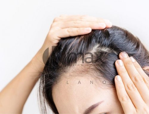 Alopecia femenina: causas y tratamientos explicados por el Tricólogo