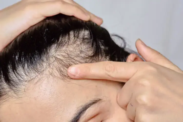 alopecia femenina frontal fibrosante