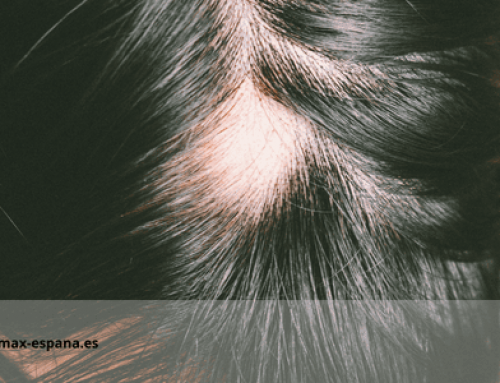 Alopecia Areata: Causas, síntomas y tratamiento para la pérdida de cabello