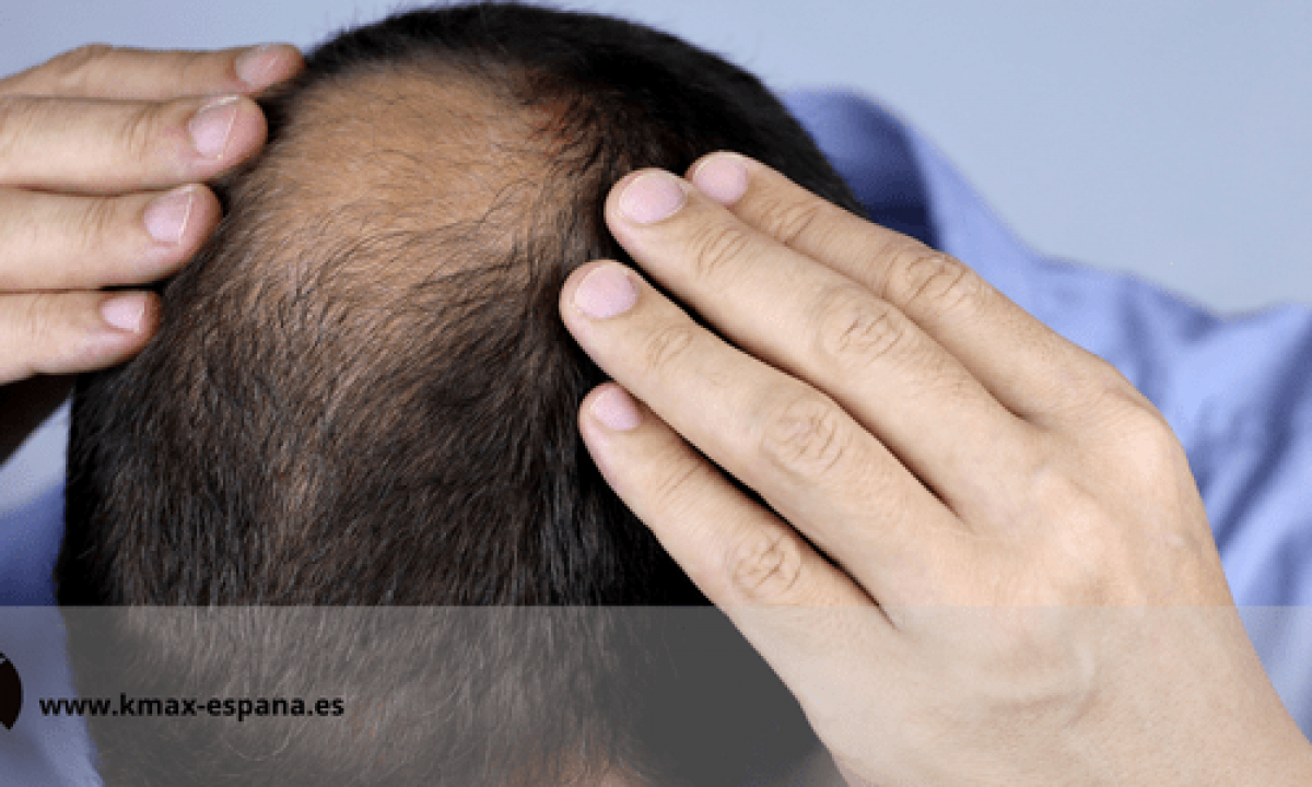 Alopecia en hombres: sombreros para usar y sentirte más seguro