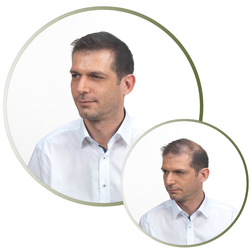 Abans i després de posar-se Fibres Capil·lars Kmax Home abans i després d'utilitzar Fibres Capil·lars Kmax