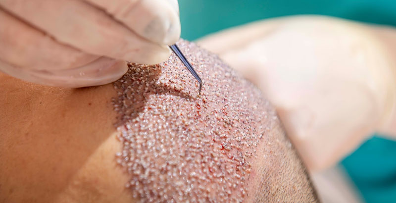 Zona receptora del cuir cabellut intervinguda en un trasplantament capil·lar