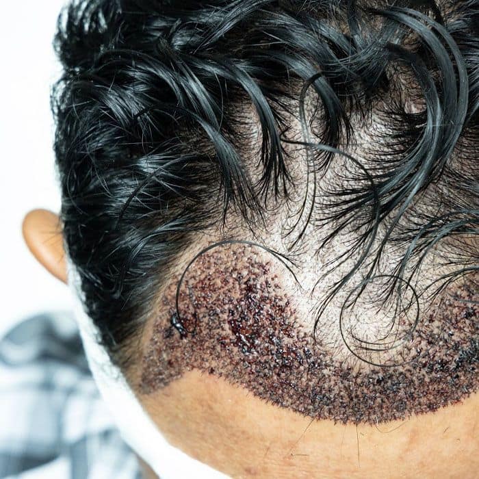 Cuir cabellut després d'un trasplantament capil·lar