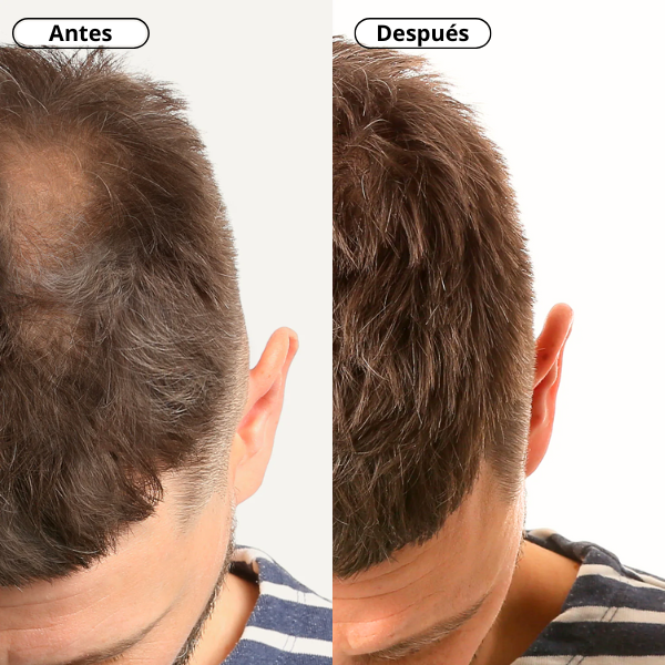 Antes y Después Fibras Capilares Kmax